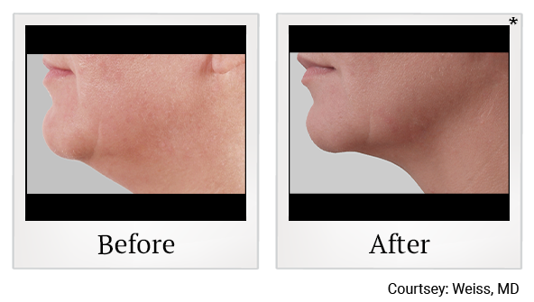 Before and After Photo 24 of Exilis Ultra 360™ treatment at SF Bay Cosmetic Surgery Medical Group in San Ramon, Pleasanton, San Jose, and Oakland