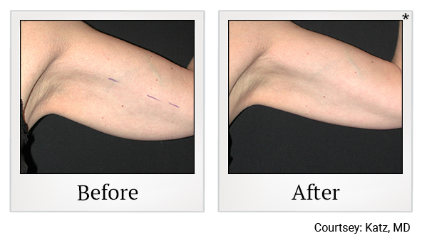 Before and After Photo 25 of Exilis Ultra 360™ treatment at SF Bay Cosmetic Surgery Medical Group in San Ramon, Pleasanton, San Jose, and Oakland