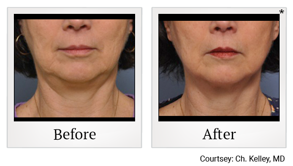 Before and After Photo 26 of Exilis Ultra 360™ treatment at SF Bay Cosmetic Surgery Medical Group in San Ramon, Pleasanton, San Jose, and Oakland