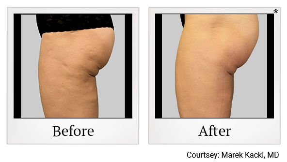 Before and After Photo 27 of Exilis Ultra 360™ treatment at SF Bay Cosmetic Surgery Medical Group in San Ramon, Pleasanton, San Jose, and Oakland
