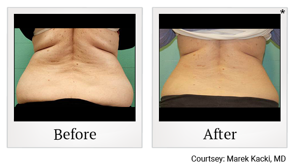 Before and After Photo 28 of Exilis Ultra 360™ treatment at SF Bay Cosmetic Surgery Medical Group in San Ramon, Pleasanton, San Jose, and Oakland