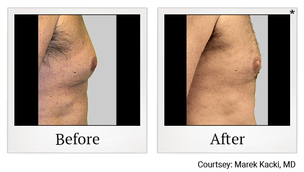 Before and After Photo 29 of Exilis Ultra 360™ treatment at SF Bay Cosmetic Surgery Medical Group in San Ramon, Pleasanton, San Jose, and Oakland
