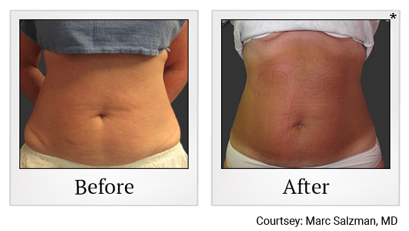 Before and After Photo 3 of Exilis Ultra 360™ treatment at SF Bay Cosmetic Surgery Medical Group in San Ramon, Pleasanton, San Jose, and Oakland