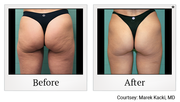 Before and After Photo 30 of Exilis Ultra 360™ treatment at SF Bay Cosmetic Surgery Medical Group in San Ramon, Pleasanton, San Jose, and Oakland
