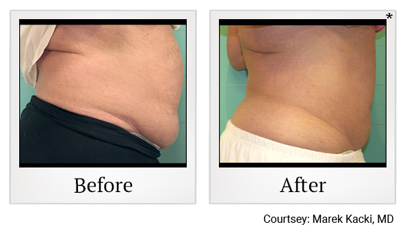 Before and After Photo 31 of Exilis Ultra 360™ treatment at SF Bay Cosmetic Surgery Medical Group in San Ramon, Pleasanton, San Jose, and Oakland