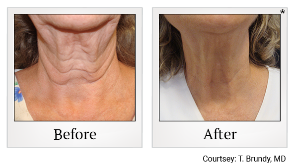 Before and After Photo 32 of Exilis Ultra 360™ treatment at SF Bay Cosmetic Surgery Medical Group in San Ramon, Pleasanton, San Jose, and Oakland