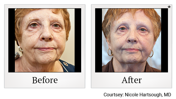 Before and After Photo 34 of Exilis Ultra 360™ treatment at SF Bay Cosmetic Surgery Medical Group in San Ramon, Pleasanton, San Jose, and Oakland
