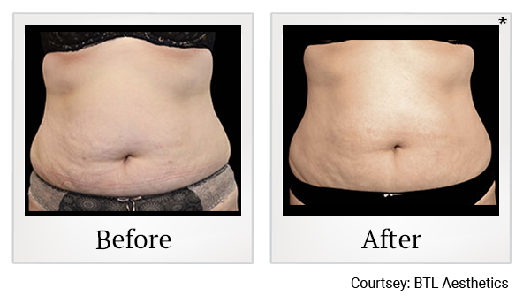 Before and After Photo 35 of Exilis Ultra 360™ treatment at SF Bay Cosmetic Surgery Medical Group in San Ramon, Pleasanton, San Jose, and Oakland