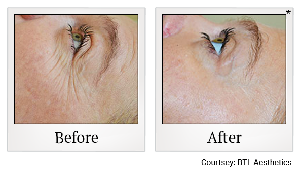 Before and After Photo 36 of Exilis Ultra 360™ treatment at SF Bay Cosmetic Surgery Medical Group in San Ramon, Pleasanton, San Jose, and Oakland