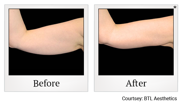 Before and After Photo 37 of Exilis Ultra 360™ treatment at SF Bay Cosmetic Surgery Medical Group in San Ramon, Pleasanton, San Jose, and Oakland