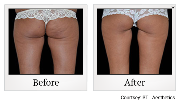 Before and After Photo 38 of Exilis Ultra 360™ treatment at SF Bay Cosmetic Surgery Medical Group in San Ramon, Pleasanton, San Jose, and Oakland