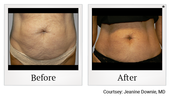 Before and After Photo 4 of Exilis Ultra 360™ treatment at SF Bay Cosmetic Surgery Medical Group in San Ramon, Pleasanton, San Jose, and Oakland