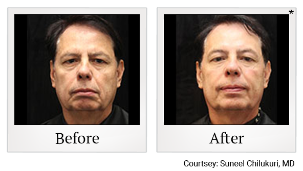 Before and After Photo 40 of Exilis Ultra 360™ treatment at SF Bay Cosmetic Surgery Medical Group in San Ramon, Pleasanton, San Jose, and Oakland