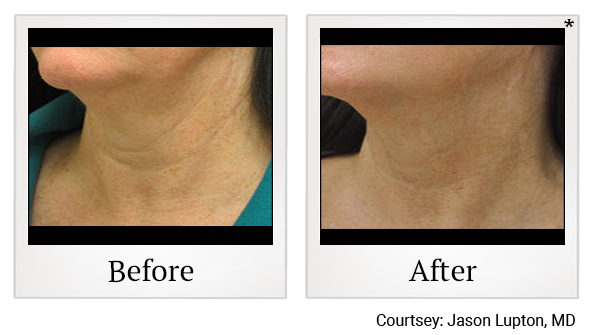 Before and After Photo 42 of Exilis Ultra 360™ treatment at SF Bay Cosmetic Surgery Medical Group in San Ramon, Pleasanton, San Jose, and Oakland