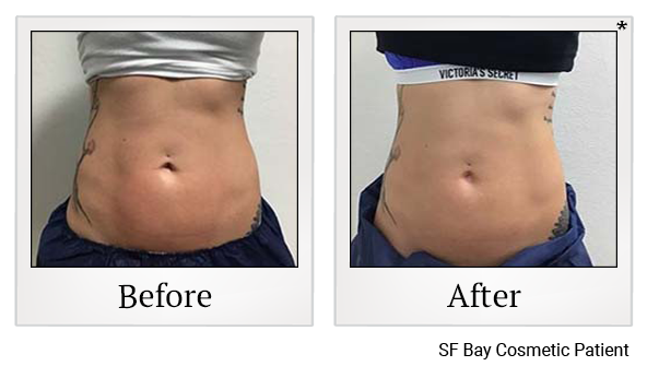 Before and After Photo 44 of Exilis Ultra 360™ treatment at SF Bay Cosmetic Surgery Medical Group in San Ramon, Pleasanton, San Jose, and Oakland