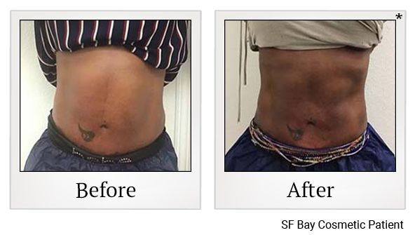 Before and After Photo 45 of Exilis Ultra 360™ treatment at SF Bay Cosmetic Surgery Medical Group in San Ramon, Pleasanton, San Jose, and Oakland