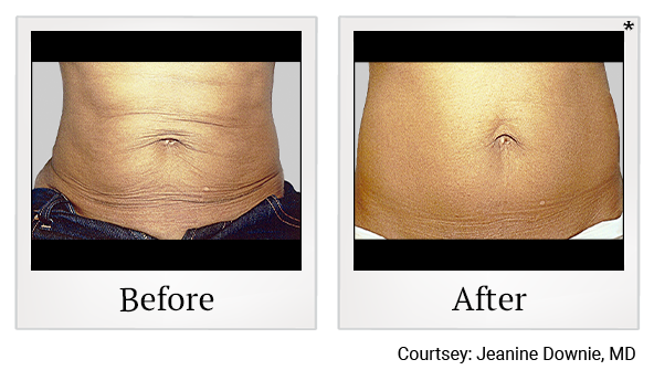 Before and After Photo 5 of Exilis Ultra 360™ treatment at SF Bay Cosmetic Surgery Medical Group in San Ramon, Pleasanton, San Jose, and Oakland