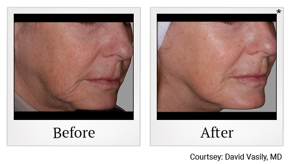 Before and After Photo 8 of Exilis Ultra 360™ treatment at SF Bay Cosmetic Surgery Medical Group in San Ramon, Pleasanton, San Jose, and Oakland