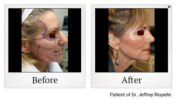 Before and After Photo 1 of Facial Rejuvenation treatment at SF Bay Cosmetic Surgery Medical Group in San Ramon