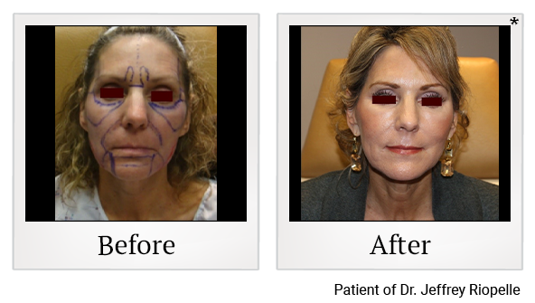Before and After Photo 2 of Facial Rejuvenation treatment at SF Bay Cosmetic Surgery Medical Group in San Ramon