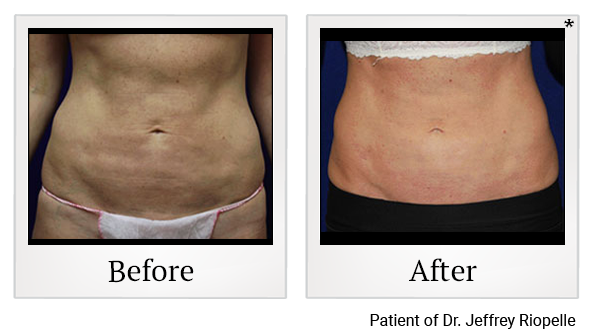 Before and After Photo 1 of Fat Transfers treatment at SF Bay Cosmetic Surgery Medical Group in San Ramon