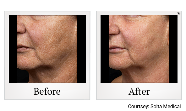 Before and After Photo 1 of Fraxel® treatment at SF Bay Cosmetic Surgery Medical Group in San Ramon, Pleasanton, San Jose, and Oakland