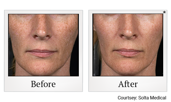 Before and After Photo 3 of Fraxel® treatment at SF Bay Cosmetic Surgery Medical Group in San Ramon, Pleasanton, San Jose, and Oakland