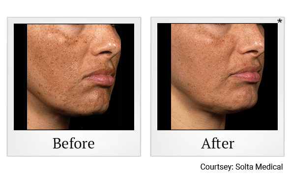Before and After Photo 4 of Fraxel® treatment at SF Bay Cosmetic Surgery Medical Group in San Ramon, Pleasanton, San Jose, and Oakland