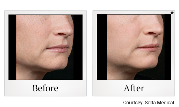 Before and After Photo 5 of Fraxel® treatment at SF Bay Cosmetic Surgery Medical Group in San Ramon, Pleasanton, San Jose, and Oakland