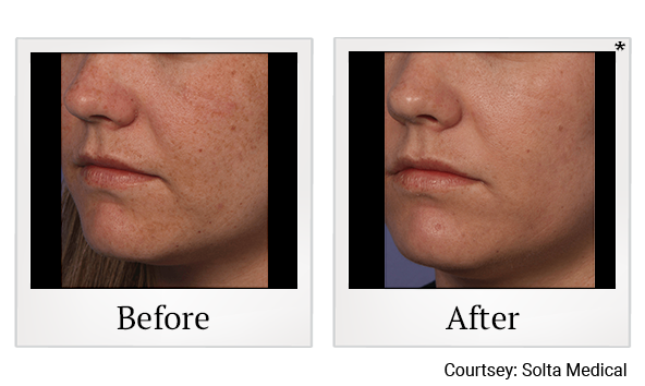 Before and After Photo 6 of Fraxel® treatment at SF Bay Cosmetic Surgery Medical Group in San Ramon, Pleasanton, San Jose, and Oakland