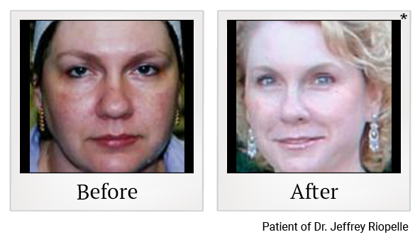 Before and After Photo 1 of IPL Photo Facial treatment at SF Bay Cosmetic Surgery Medical Group in San Ramon