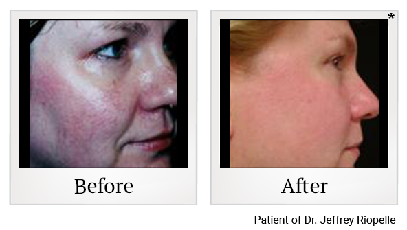 Before and After Photo 2 of IPL Photo Facial treatment at SF Bay Cosmetic Surgery Medical Group in San Ramon