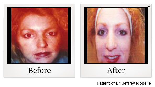 Before and After Photo 3 of IPL Photo Facial treatment at SF Bay Cosmetic Surgery Medical Group in San Ramon, Pleasanton, San Jose, and Oakland
