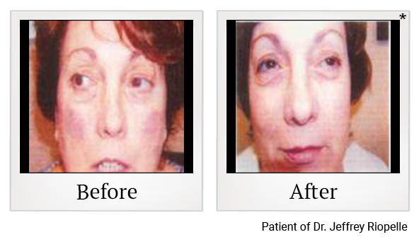 Before and After Photo 4 of IPL Photo Facial treatment at SF Bay Cosmetic Surgery Medical Group in San Ramon, Pleasanton, San Jose, and Oakland