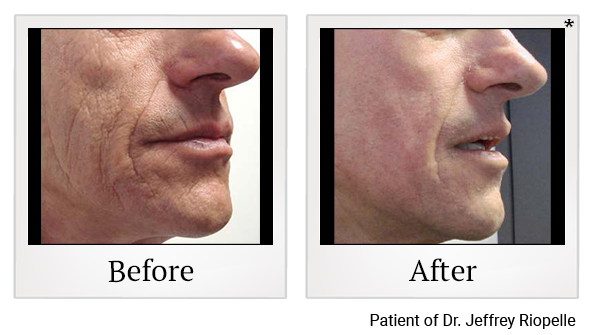 Before and After Photo 1 of JPlasma Portrait treatment at SF Bay Cosmetic Surgery Medical Group in San Ramon