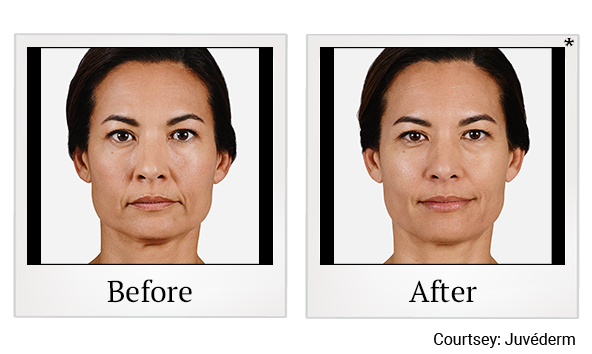 Before and After Photo 3 of Juvéderm® Fillers treatment at SF Bay Cosmetic Surgery Medical Group in San Ramon