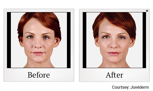 Before and After Photo 10 of Juvéderm® treatment at SF Bay Cosmetic Surgery Medical Group in San Ramon
