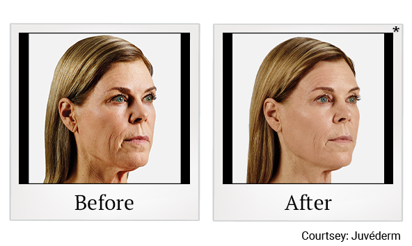 Before and After Photo 11 of Juvéderm® treatment at SF Bay Cosmetic Surgery Medical Group in San Ramon