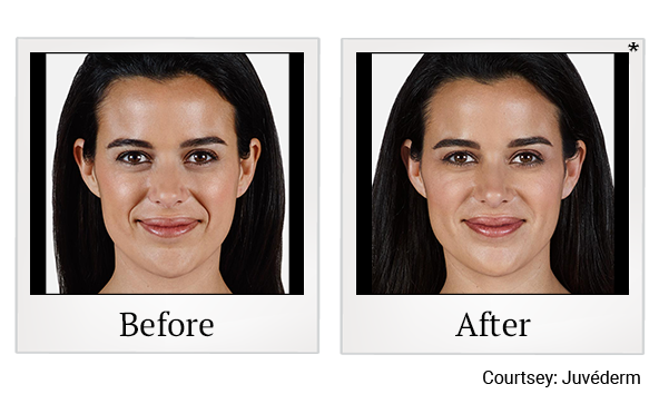 Before and After Photo 4 of Juvéderm® Fillers treatment at SF Bay Cosmetic Surgery Medical Group in San Ramon