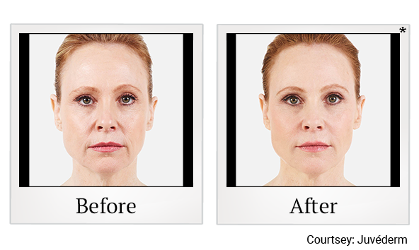 Before and After Photo 14 of Juvéderm® treatment at SF Bay Cosmetic Surgery Medical Group in San Ramon