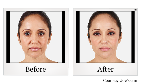 Before and After Photo 15 of Juvéderm® treatment at SF Bay Cosmetic Surgery Medical Group in San Ramon