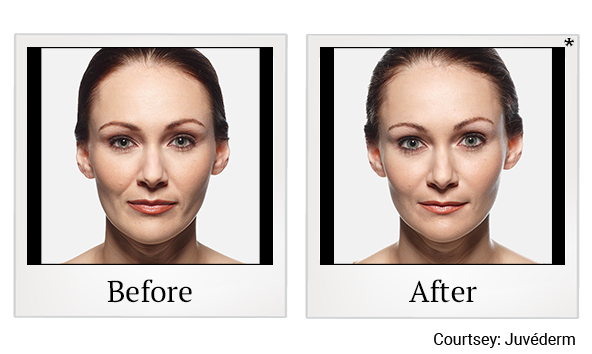 Before and After Photo 16 of Juvéderm® treatment at SF Bay Cosmetic Surgery Medical Group in San Ramon