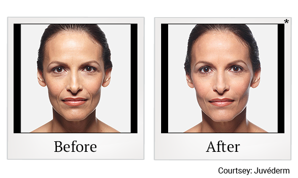 Before and After Photo 17 of Juvéderm® treatment at SF Bay Cosmetic Surgery Medical Group in San Ramon