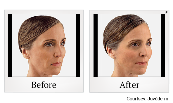 Before and After Photo 18 of Juvéderm® treatment at SF Bay Cosmetic Surgery Medical Group in San Ramon