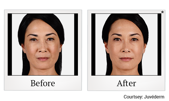 Before and After Photo 19 of Juvéderm® treatment at SF Bay Cosmetic Surgery Medical Group in San Ramon