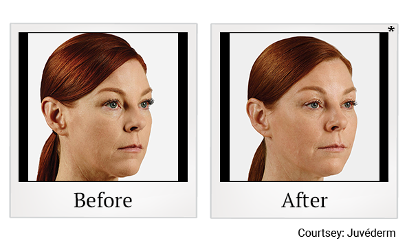 Before and After Photo 20 of Juvéderm® treatment at SF Bay Cosmetic Surgery Medical Group in San Ramon