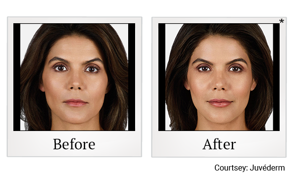 Before and After Photo 6 of Juvéderm® Fillers treatment at SF Bay Cosmetic Surgery Medical Group in San Ramon