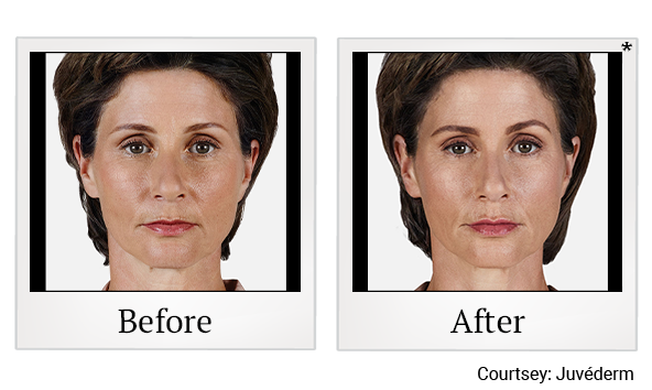 Before and After Photo 4 of Juvéderm® treatment at SF Bay Cosmetic Surgery Medical Group in San Ramon
