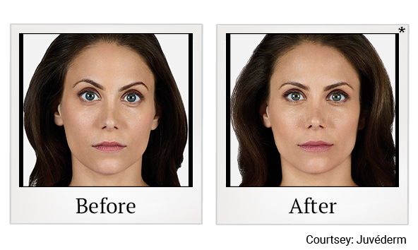 Before and After Photo 5 of Juvéderm® treatment at SF Bay Cosmetic Surgery Medical Group in San Ramon