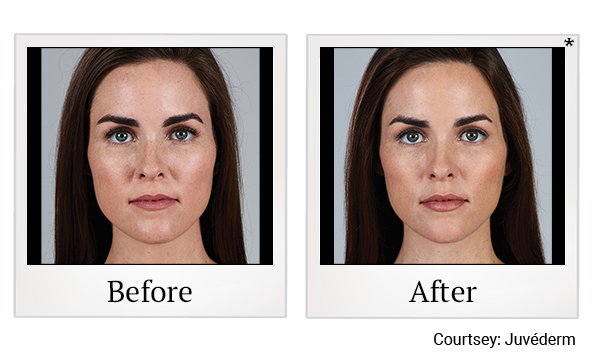 Before and After Photo 6 of Juvéderm® treatment at SF Bay Cosmetic Surgery Medical Group in San Ramon